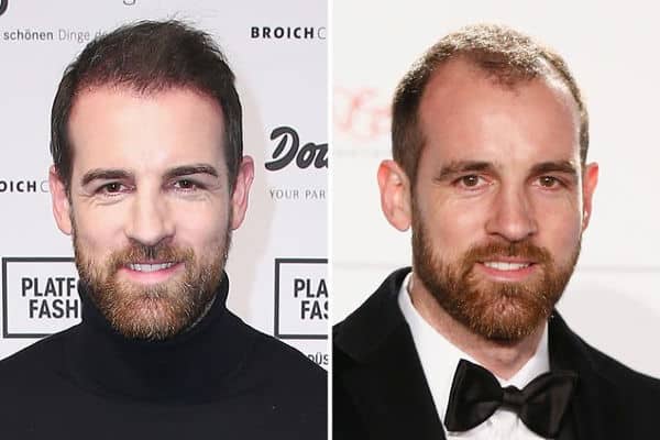 Finest Hair Transplant in Turkey