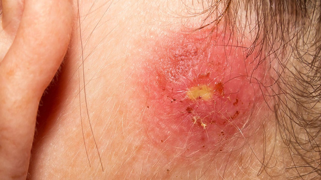 Staph Pores and skin An infection Remedies – Is There A Remedy For Staph?
